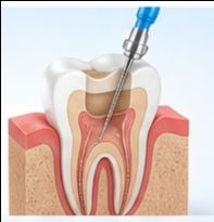 Painless Root Canal Treat