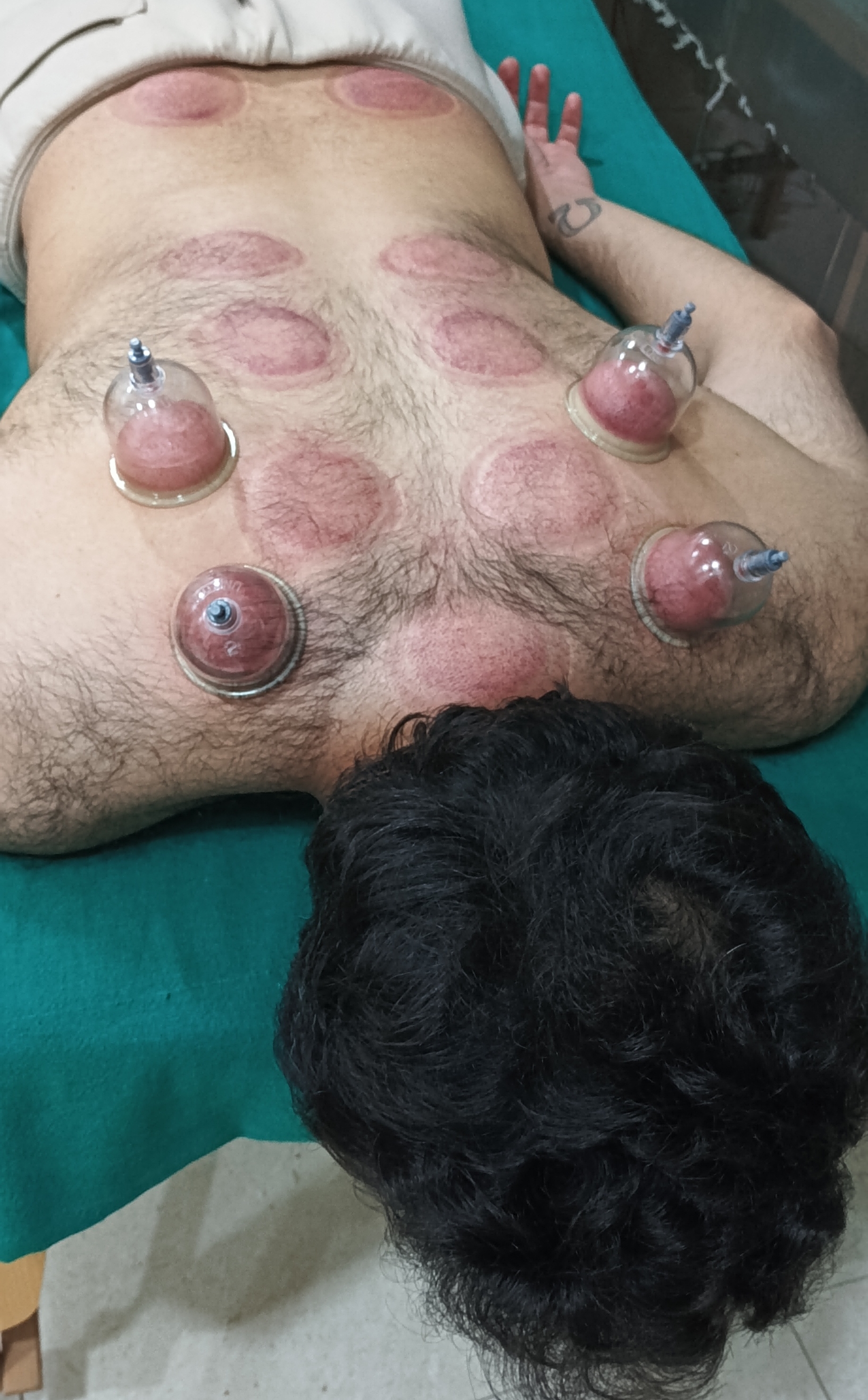 Cupping Therapy Set view 2