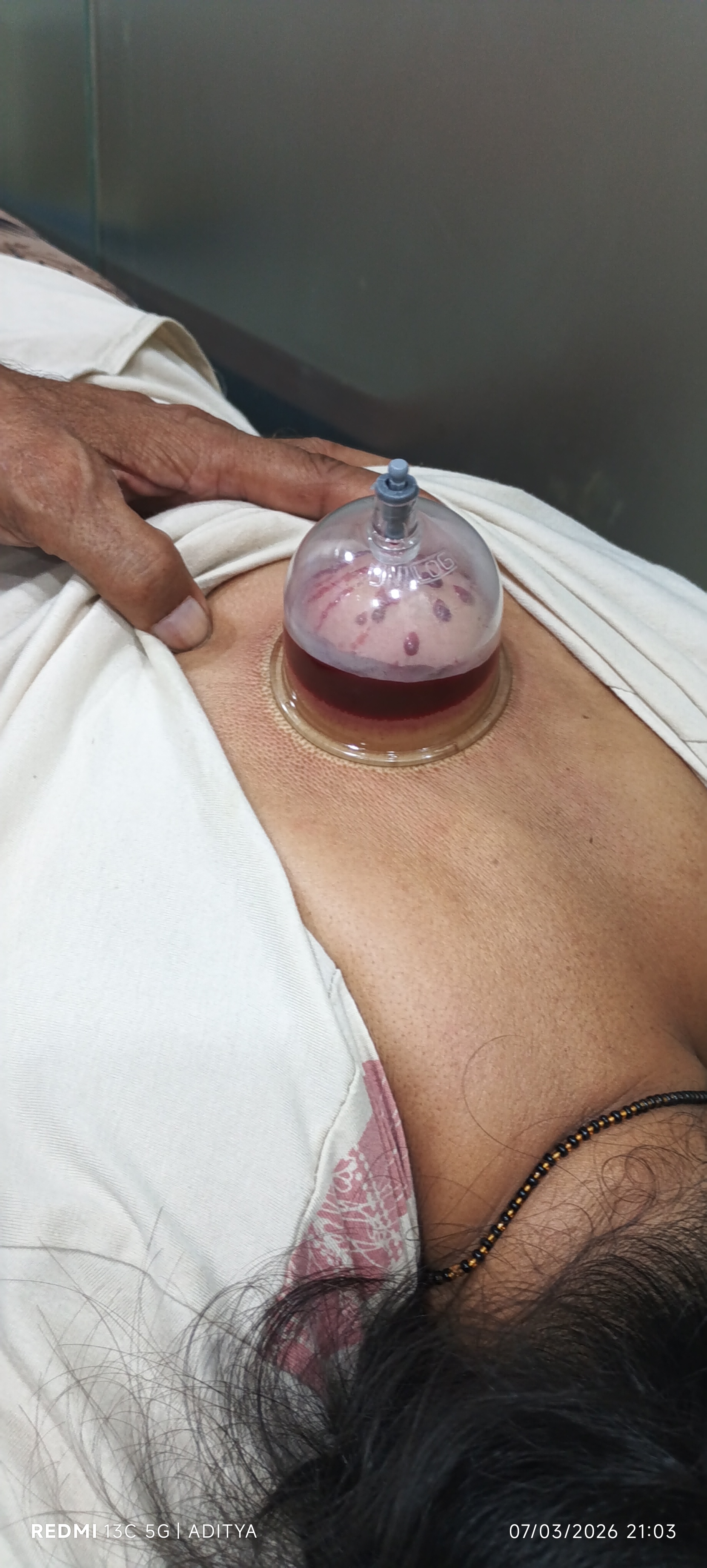 Suction Cupping Set view 2