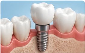 Dental Implant view 2