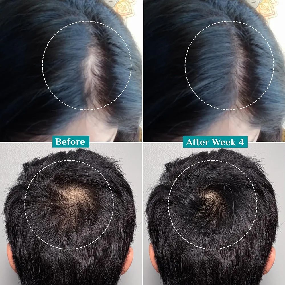 Pilgrim Advanced Hair Growth Serum Roll On with Redensyl & AnaGain - 25ml
New Hair Growth in 28 Days, Korean Black Rice, Rosemary, Reduce Hair Fall, Hair Regrowth, Increase Hair Density, Thicker Hair view 5