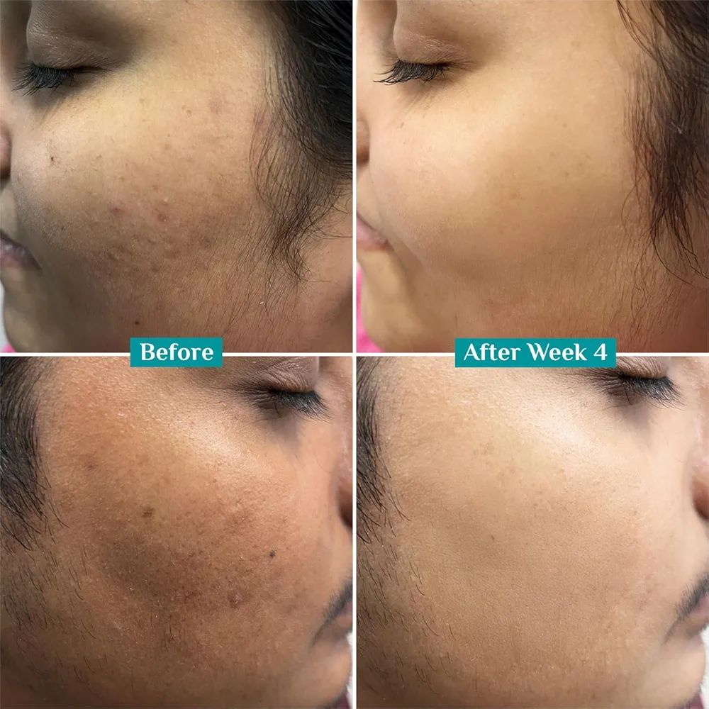 Pilgrim 10% Vitamin C Serum for Glowing Skin|With 5% Niacinamide, Hyaluronic & Glycolic Acid|Fades Dark Spots, Pigmentation|For All, Oily, Combination, Normal Skin |Beginner Friendly - Men, Women view 4