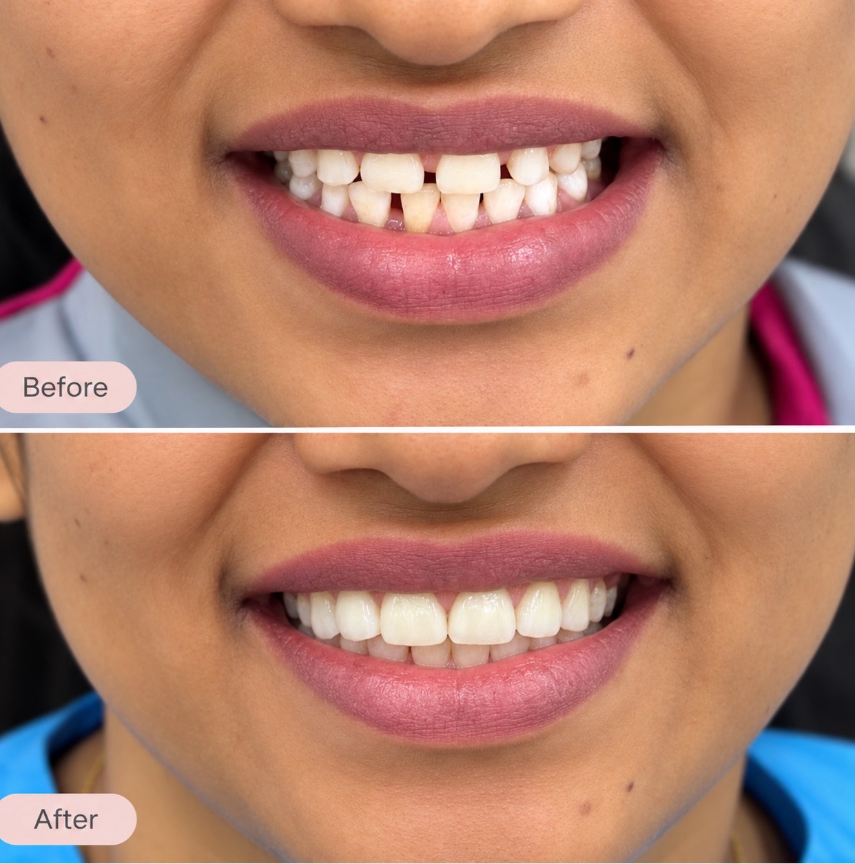 Smile Designing For Gaps & Discoloured Teeth