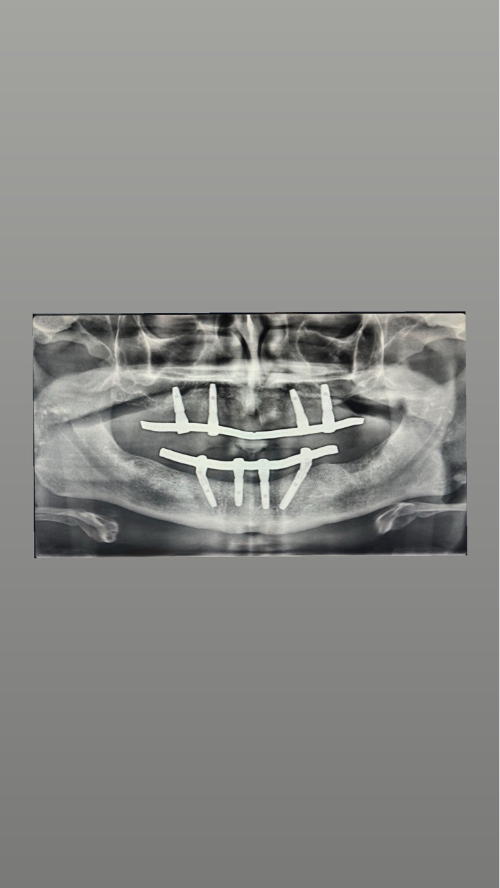 Fixed Full Mouth Implant Bridge view 2