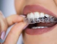 Invisible Aligners